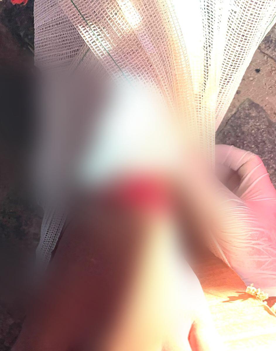 Adolescente sofre fratura exposta após acidente de moto no bairro Fluminense em Conceição do Coité; ele será transferido em caráter de urgência para Feira de Santana