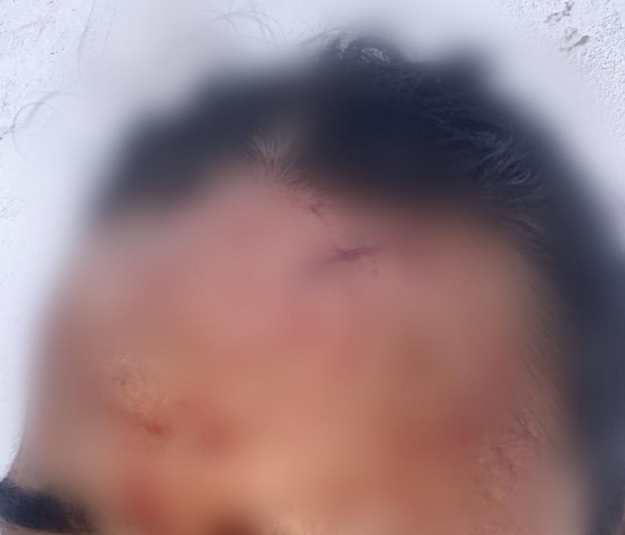 Mulher sofre cortes no rosto após agressão com copo de vidro pela ‘melhor amiga’ no bairro Alto da Colina em Conceição do Coité