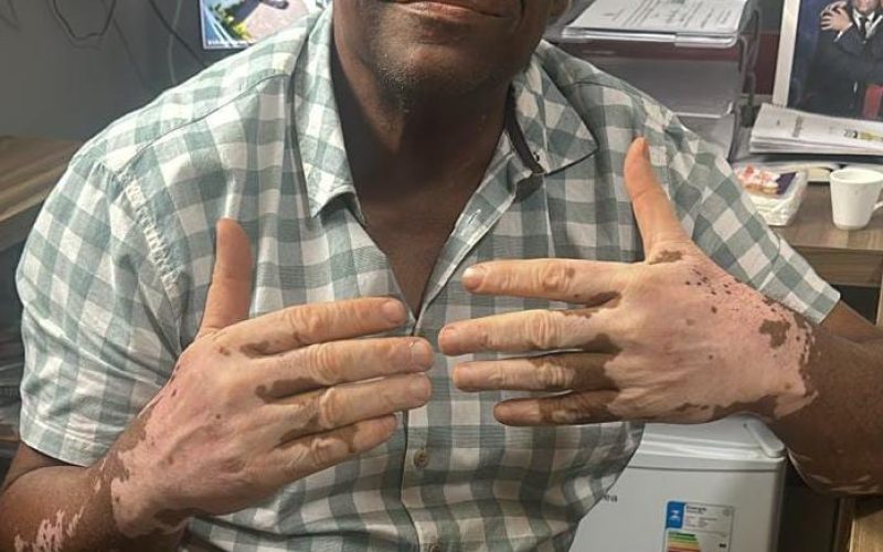 Coité: Portador de vitiligo, presidente da Câmara de Vereadores relata comentários preconceituosos e dispara:  “A sociedade precisa aceitar do jeito que somos”