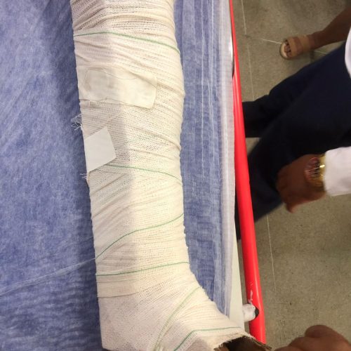 Homem sofre fratura ao cair durante partida de futebol em Conceição do Coité