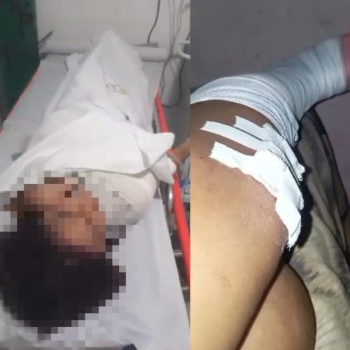 “Minha filha grita de dor”, diz mãe após acidente entre motos em Conceição do Coité; ela sofreu fratura no pé e a garota teve fratura na clavícula