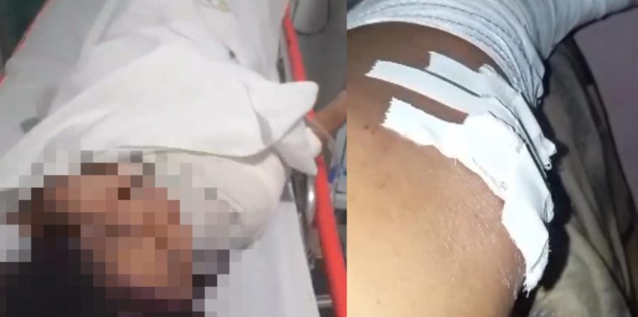 “Minha filha grita de dor”, diz mãe após acidente entre motos em Conceição do Coité; ela sofreu fratura no pé e a garota teve fratura na clavícula