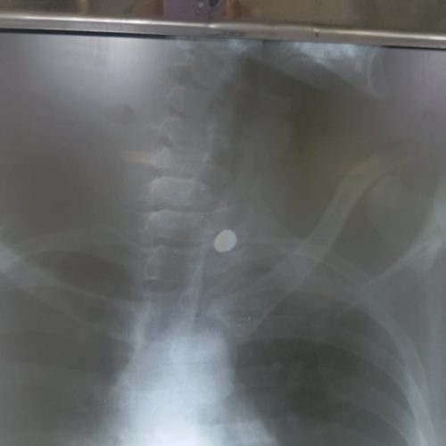 Jovem baleado em ação da PRE em Conceição do Coité recebe alta, sofre fraturas e volta para casa com projétil no corpo; cirurgia poderia causar tetraplegia