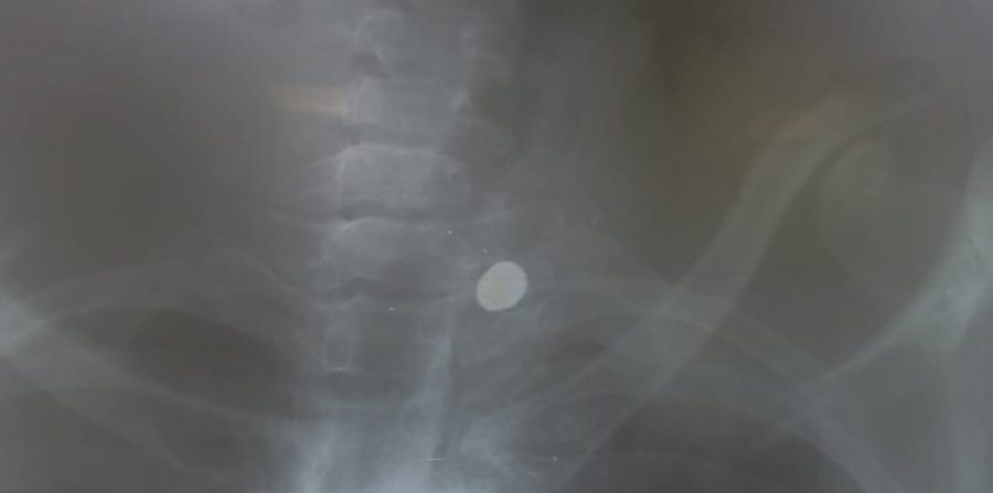 Jovem baleado em ação da PRE em Conceição do Coité recebe alta, sofre fraturas e volta para casa com projétil no corpo; cirurgia poderia causar tetraplegia