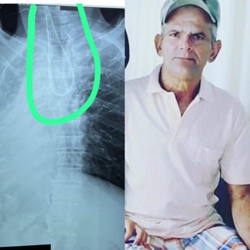 Retirolândia: família denuncia suposto erro de profissionais da saúde após alimento ser administrado no pulmão, em vez do sistema digestivo, de idoso de 68 anos; vítima está em estado gravíssimo
