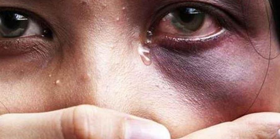 “Você vai ficar careca e vou lhe mostrar que você não fica comigo e nem com ninguém”: mulher relata socos no rosto, mordidas e tentativa de arrancar dedo pelo companheiro em Conceição do Coité
