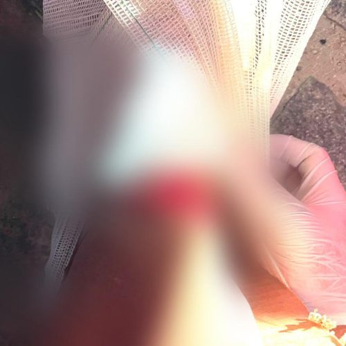 Adolescente sofre fratura exposta após acidente de moto no bairro Fluminense em Conceição do Coité; ele será transferido em caráter de urgência para Feira de Santana