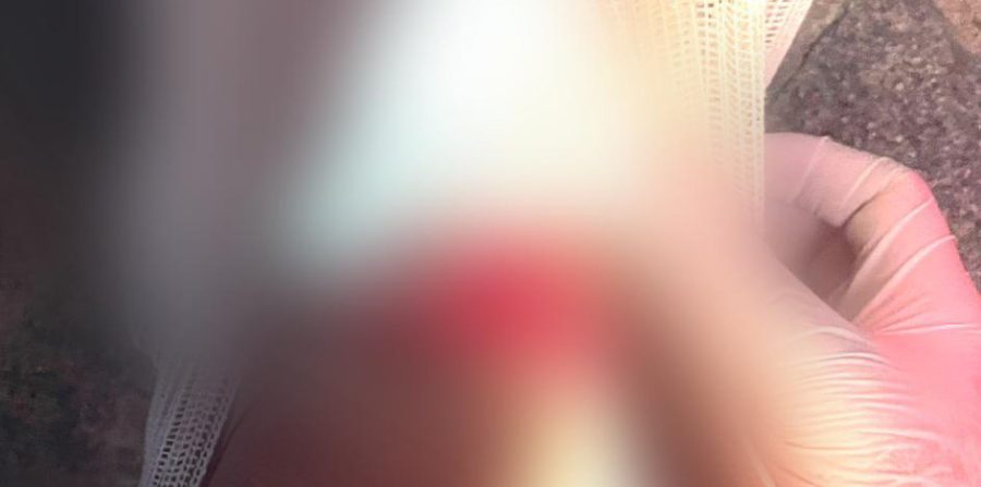 Adolescente sofre fratura exposta após acidente de moto no bairro Fluminense em Conceição do Coité; ele será transferido em caráter de urgência para Feira de Santana