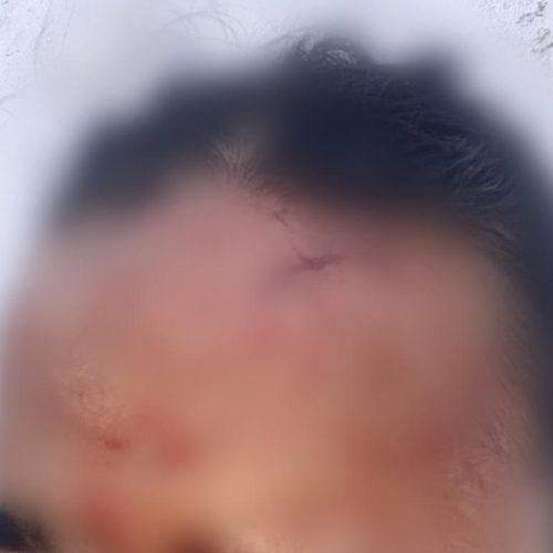 Mulher sofre cortes no rosto após agressão com copo de vidro pela ‘melhor amiga’ no bairro Alto da Colina em Conceição do Coité