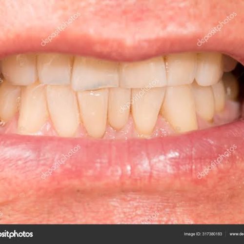 Homem morde lábio da namorada, causa hemorragia e foge após agressão na zona rural de Conceição do Coité